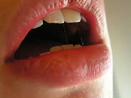 Dry Mouth Destruction (Xerostomia)